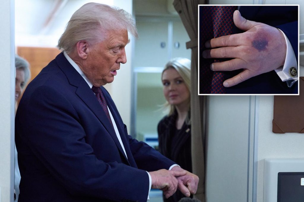 Trump blames hand bruise at Davos on aspirin
