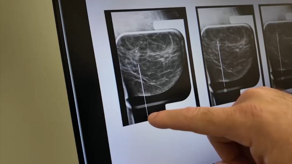 Stony Brook's Cancer Center accepting patients for breast cancer clinical trial