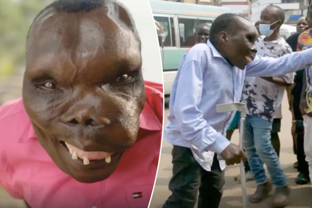 ‘World’s ugliest man’ has disease that turns muscles into bone 'World's ugliest man' has disease that turns muscles into bone