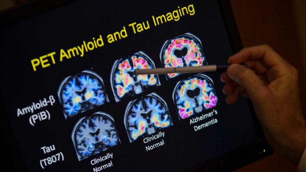 What is Alzheimer’s disease? Signs, symptoms and progression after Capt. Sully, Bill Ritter diagnosed What is Alzheimer's disease? Signs, symptoms and progression after Capt. Sully, Bill Ritter diagnosed